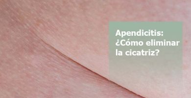 Eliminar cicatriz de apendicitis