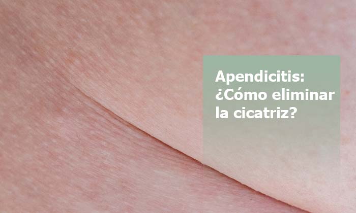 eliminar cicatriz apendicitis