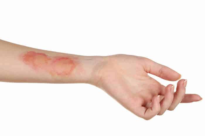 brazo con herida de quemadura que se puede tratar con parches cicatrizantes