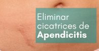 eliminar la cicatriz de apendicitis o peritonitis con parches cicatrizantes de silicona