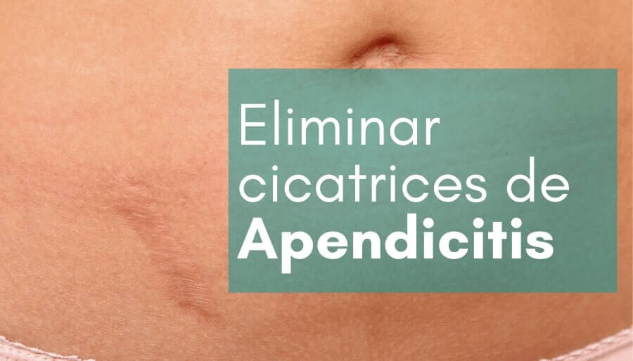 eliminar la cicatriz de apendicitis o peritonitis con parches cicatrizantes de silicona