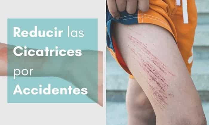 Cómo eliminar cicatrices causadas por accidentes, quemaduras, cortes