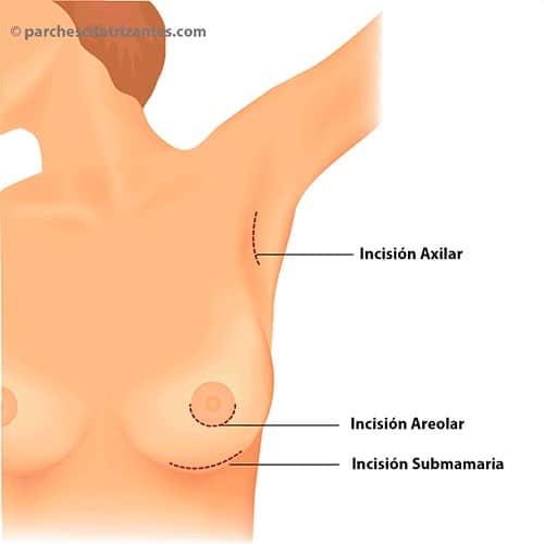 Las diferentes cicatrices por aumento de pecho: Cicatriz Submamaria, Cicatriz Axilar, Cicatriz Areolar o Periareolar