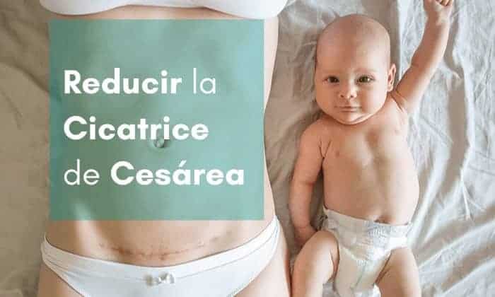 Parches para Cesárea: mejores reductores de cicatrices de cesárea