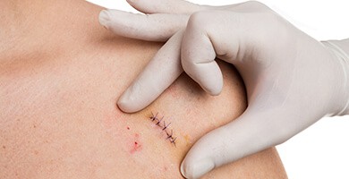 Parches de Silicona para reducir cicatrices quirúrgicas