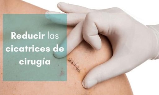 Eliminar Cicatriz Quirúrgica con parches para cicatrices quirúrgicas