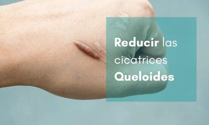 ¿Qué son los Queloides y cómo se pueden Tratar o Eliminar?
