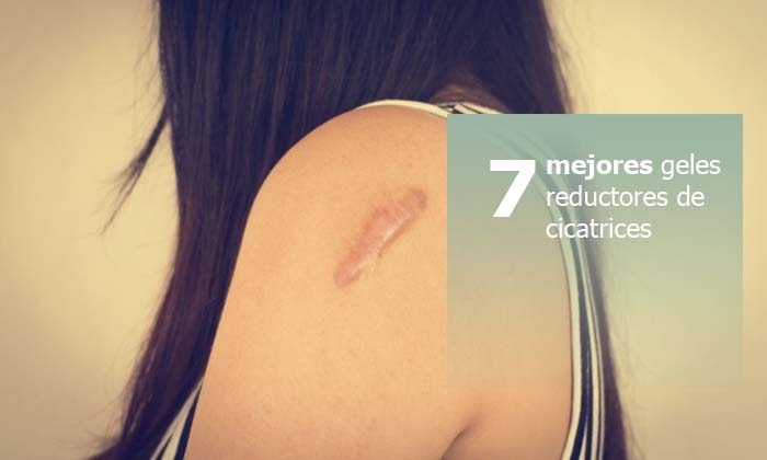 imagen portada del post mejores cremas cicatrizantes 2021 - mujer con queloide en el brazo