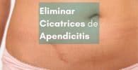 eliminar la cicatriz de apendicitis o peritonitis con parches cicatrizantes de silicona