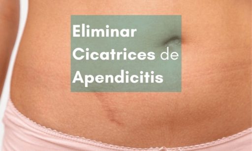 eliminar la cicatriz de apendicitis o peritonitis con parches cicatrizantes de silicona