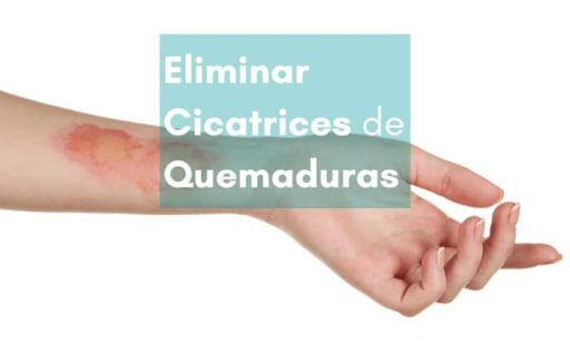 Cómo Eliminar Cicatrices de Quemaduras con Parches Cicatrizantes