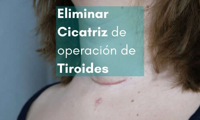 eliminar cicatriz operación tiroide con parches de silicona para cicatrices