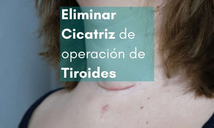 eliminar la cicatriz de tiroide con parches de silicona para cicatrices eliminar cicatriz operación tiroide con parches de silicona para cicatrices