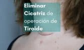 eliminar cicatriz operación tiroide con parches de silicona para cicatrices