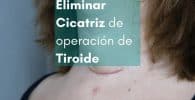 eliminar cicatriz operación tiroide con parches de silicona para cicatrices