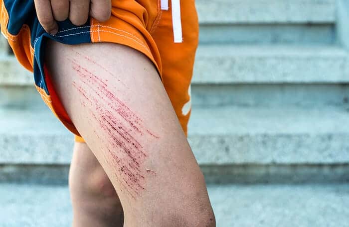 imagen de pierna de joven con raspones que se puede tratar con parches cicatrizantes