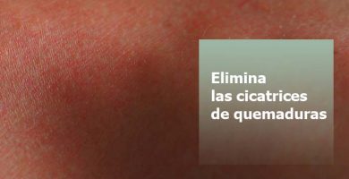Cicatrices por quemaduras