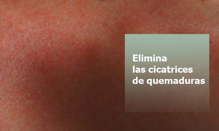 Elimina las cicatrices de quemaduras