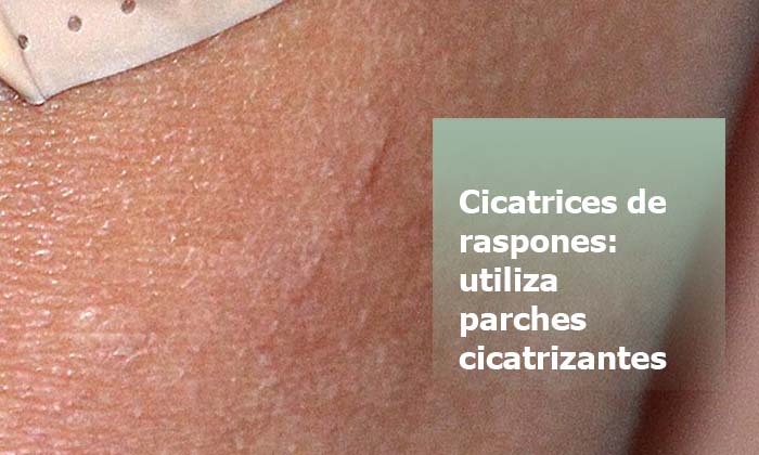eliminar Cicatrices de raspones Reducir o eliminar cicatrices de raspones con parches cicatrizantes